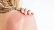 header-wat-te-doen-als-je-toch-verbrand-bent